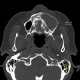 Periapical cyst, radicular cyst: CT - Computed tomography